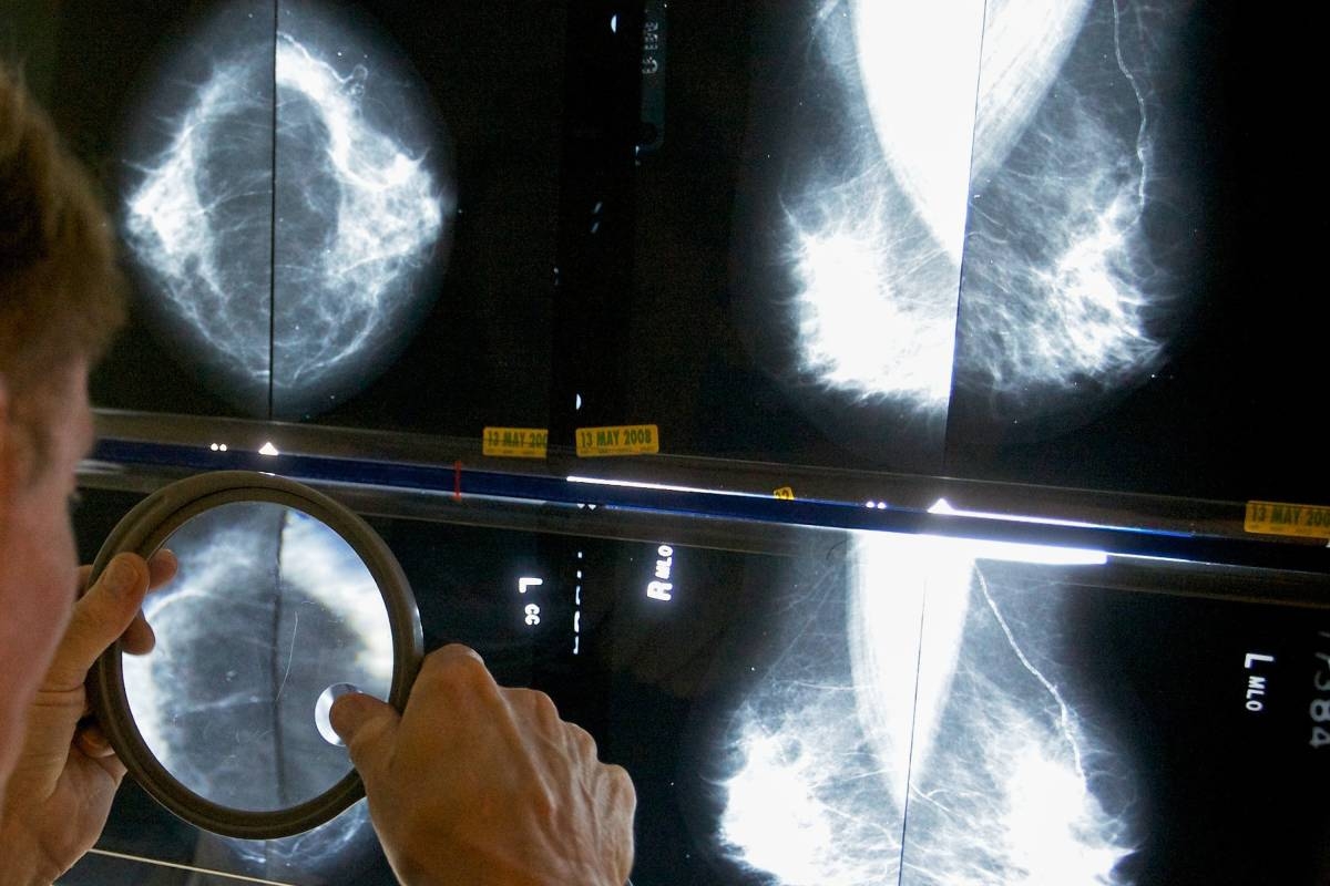 Mammogram Guideline Split Creates Screening Market Crossroads