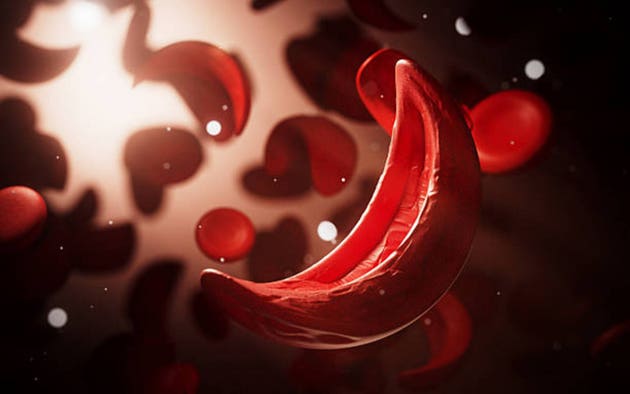 Vertex Casgevy OK'd for Kids as Young as 2 in Sickle Cell, Thalassemia